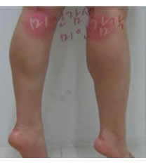 美感整形外科-韩国美感整形医院注射瘦腿对比图