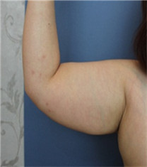 韩国Bommaru皮肤科-手臂吸脂对比图