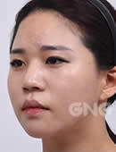 韩国GNG整形医院-GNG隆鼻手术：提升颜值还可解决鼻炎困扰