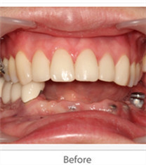 MagicKiss牙科-种植牙案例