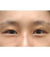 韩国李喜文整形医院修复双眼皮对比图