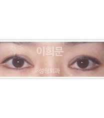 韩国李喜文整形医院眼部矫正对比图