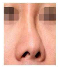 韩国春光整形外科歪鼻矫正对比图