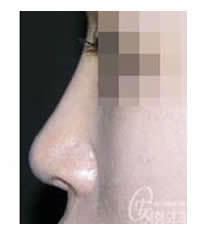 韩国安成丰整形医院鼻尖延长术对比图