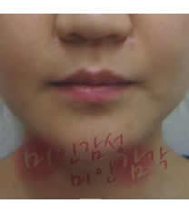 美感整形外科-韩国美感整形医院瘦咬肌对比图