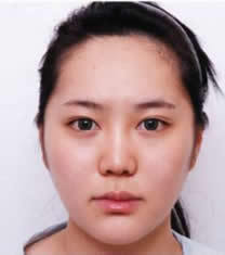 韩国POSE整形外科下颌角整形对比图