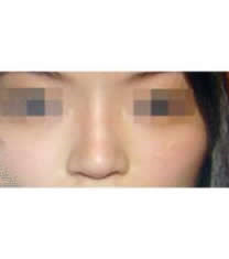 韩国MEYOU整形外科-韩国ME&YOU整形外科注射隆鼻对比图