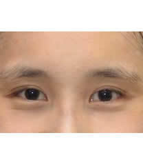 韩国李喜文整形医院修复双眼皮对比图_术后