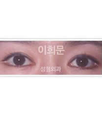 韩国李喜文整形医院眼部矫正对比图