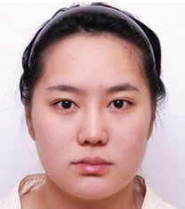 韩国pose整形外科-韩国POSE整形外科下颌角整形对比图