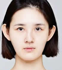 韩国CLAIR整形外科歪鼻矫正对比图