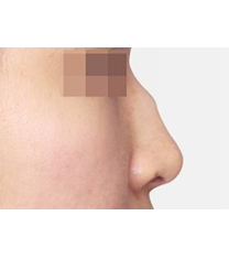 爱琳整形外科-驼峰鼻矫正对比案例