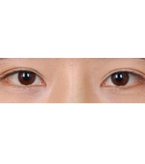 韩国李学秀整形医院-双眼皮手术对比日记