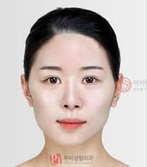 爱琳整形外科-爱琳整形医院左右脸不对称矫正对比图