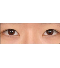 韩国李学秀整形医院-双眼皮手术对比日记