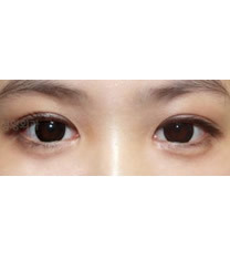 爱琳整形外科-爱琳整形外科眼部综合整形对比图
