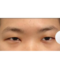 韩国天鹅整形外科眼部综合整形对比图_术前