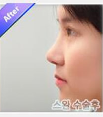 韩国天鹅整形外科隆鼻手术对比图_术后
