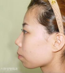 韩国天鹅整形外科双颚手术对比图