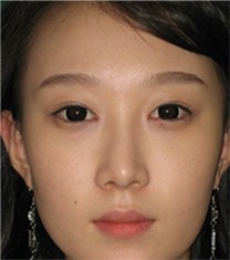 韩国CNMcoanmi外科双眼皮案例_术后