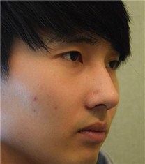 韩国CNM（coanmi）外科鼻部矫正日记
