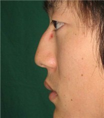 韩国CNM（coanmi）外科隆鼻案例