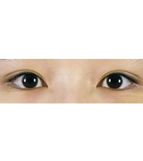 爱琳整形外科-爱琳整形外科开眼角+埋线双眼皮对比图