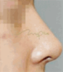 驼峰鼻矫正案例
