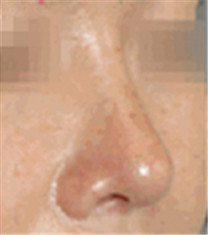 鼻综合整形对比案例