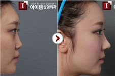 爱婷与拉里整形医院韩式小翘鼻案例+效果对比