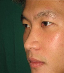 韩国CNM（COANMI）整形外科医院鹰钩鼻案例对比图	