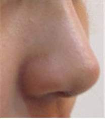 狎鸥亭Line整形外科-隆鼻对比案例