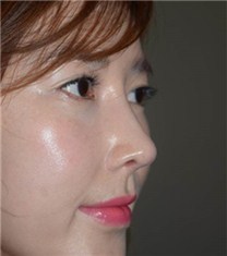 韩国可安美（CNM）整形外科鼻子修复对比图_术后