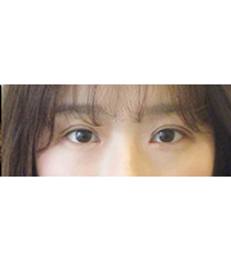 韩国CNMcoanmi外科整形双眼皮手术案例对比图