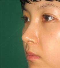 韩国CNMcoanmi整形外科医院自体软骨隆鼻案例