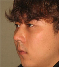 韩国CNMcoanmi外科整形驼峰鼻整形对比案例_术后