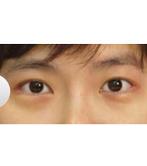 韩国天鹅整形外科眼部综合整形对比图_术后