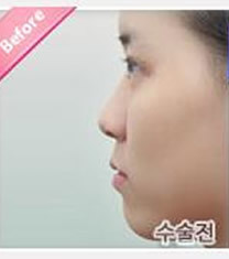 韩国天鹅整形外科隆鼻手术对比图_术前
