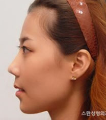 韩国天鹅整形外科-韩国天鹅整形外科双颚手术对比图