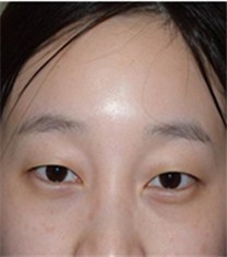 韩国CNM（COANMI）整形外科医院双眼皮案例_术前