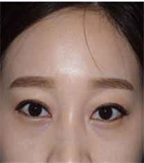 韩国CNM（COANMI）整形外科医院双眼皮案例_术后