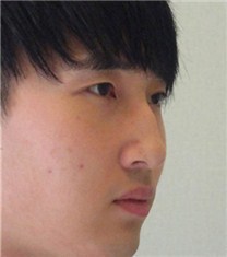 韩国CNM（coanmi）外科鼻部矫正日记