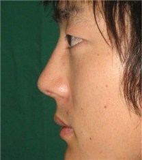 韩国CNM（coanmi）外科隆鼻案例