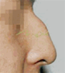 驼峰鼻矫正案例