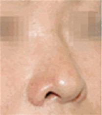 鼻综合整形对比案例