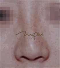 美Plus整形外科-自体软骨隆鼻对比日记