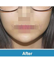 韩国史丹利整形医院注射玻尿酸垫下巴对比图