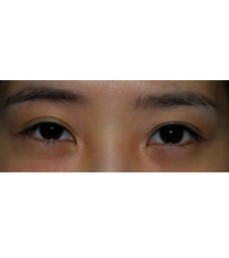 ROCOCO整形外科-双眼皮对比案例