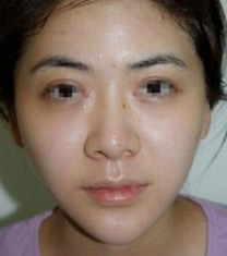 韩国史丹利整形医院瘦脸+祛痘对比图