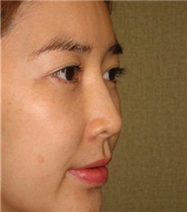 韩国CNMcoanmi整形-韩国可安美（CNM）整形外科鼻子修复对比图